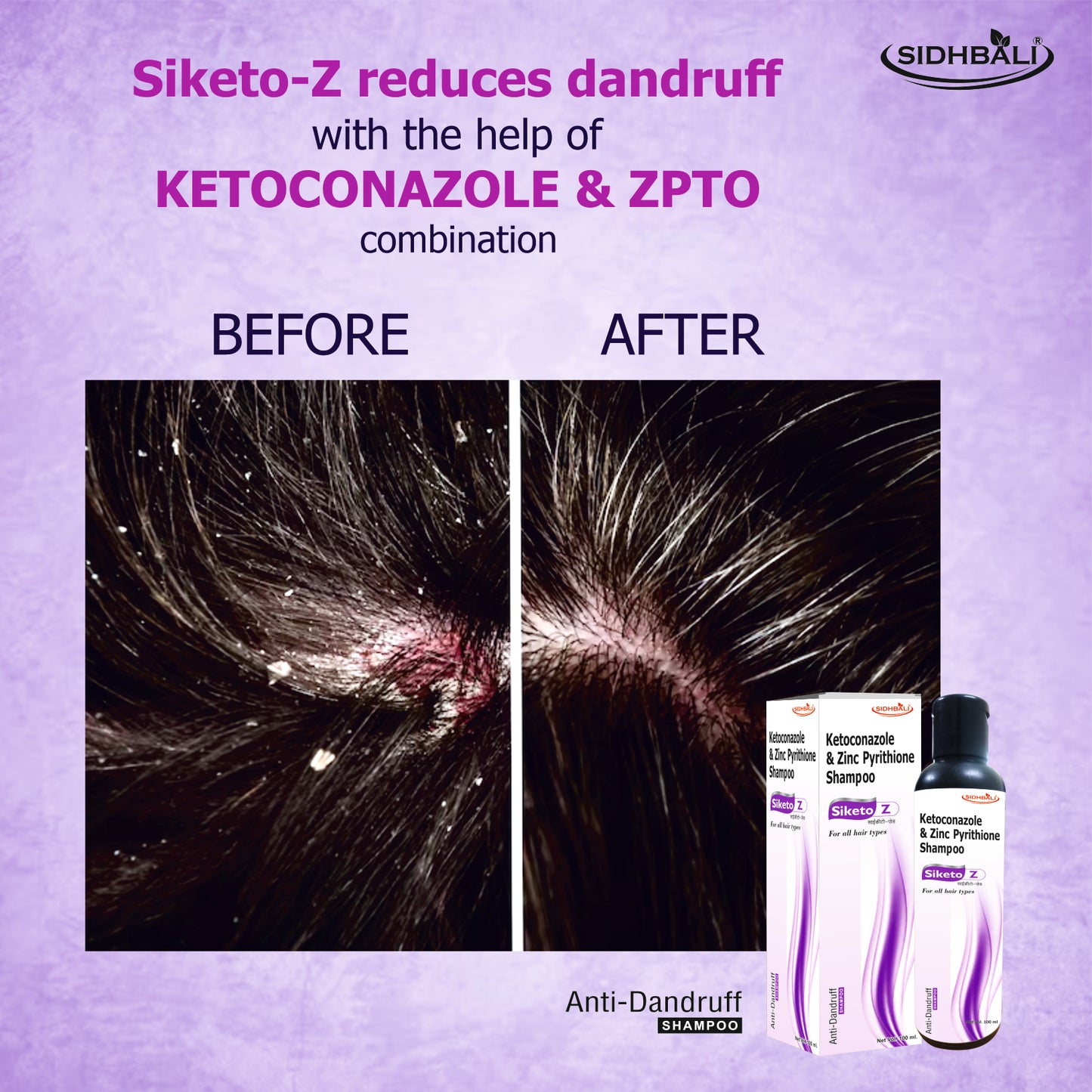 Siketo Z Anti-Dandruff Shampoo – Ketoconazole & Zinc Pyrithione | 100ml | For All Hair Types | Fights Dandruff, Itching & Scalp Flaking | Nourishes Scalp for Healthy, Shiny Hair